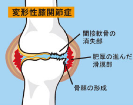 膝痛 に サプリメント は効果があるのか 膝痛 に対処するための 私の健康法 をご紹介します 団塊世代の我楽多 がらくた 帳